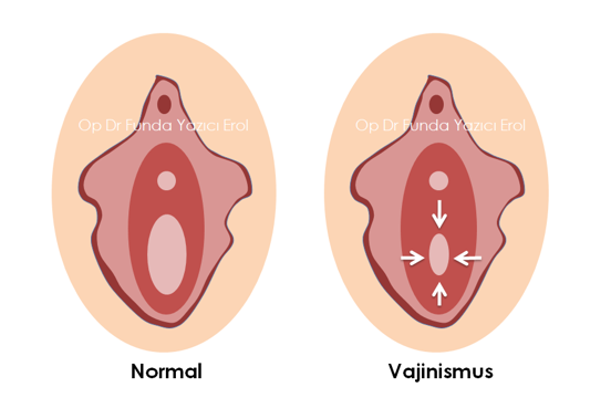 Vajinismus Tedavisi Fiyatları 2025